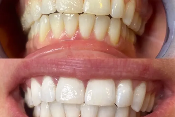 Antes y después de un tratamiento estético dental